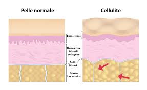 Cellulite. Come combatterla?