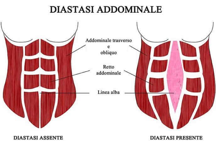 Diastasi addominale